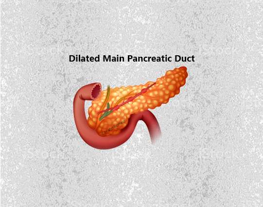 Dilated  Main Pancreatitis Duct
